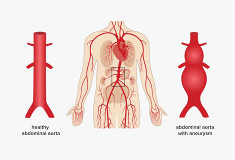 Abdominal Aortic Aneurysms