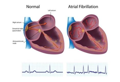 Atrial Fibrillation
