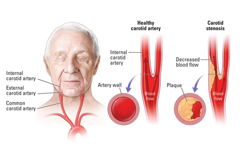 Carotid Artery Disease
