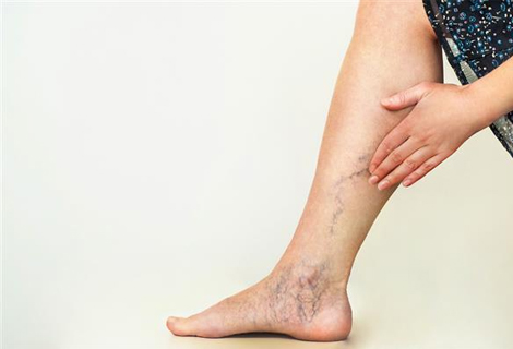 Peripheral Artery Disease