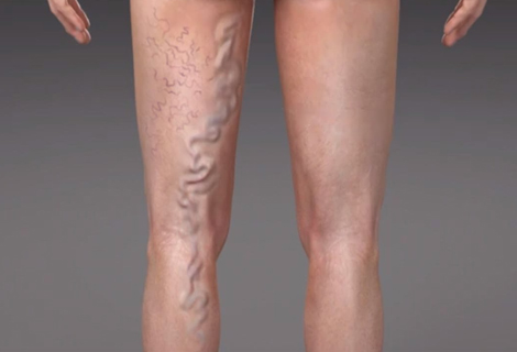 Varicose Veins