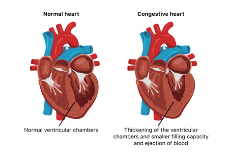 Congestive Heart Failure