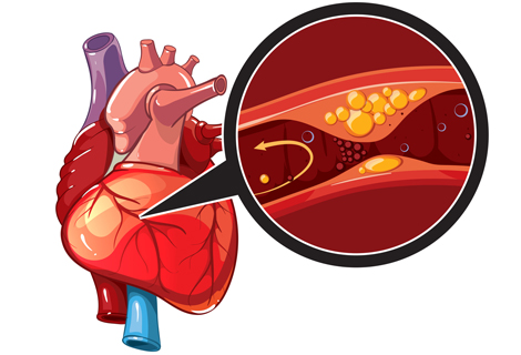 coronary artery disease